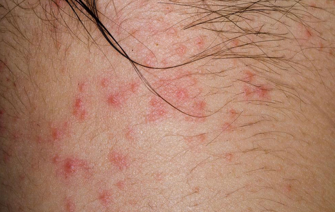 An Introduction to the Types of Itchy Skin Rashes