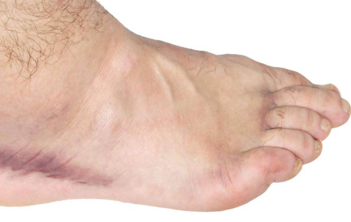 Get Easy Relief from Your Swollen Ankle