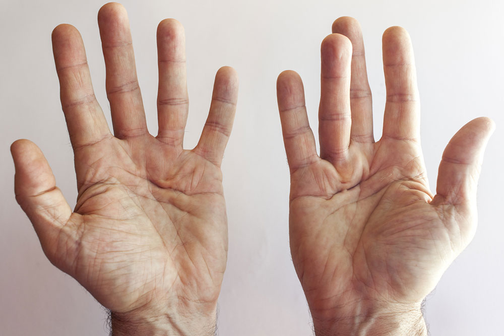 Dupuytren’s Contracture &#8211; Its Symptoms and Causes