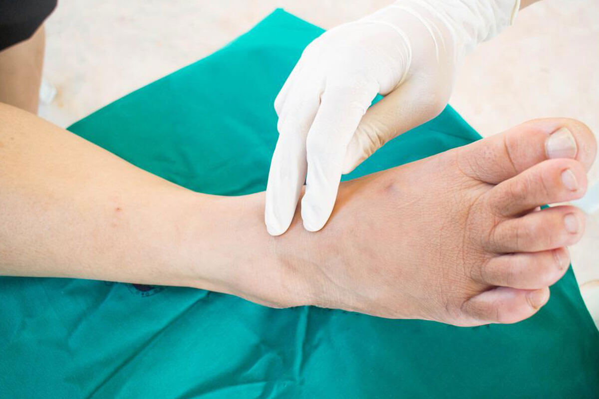 How to Alleviate Your Diabetes Foot Problems