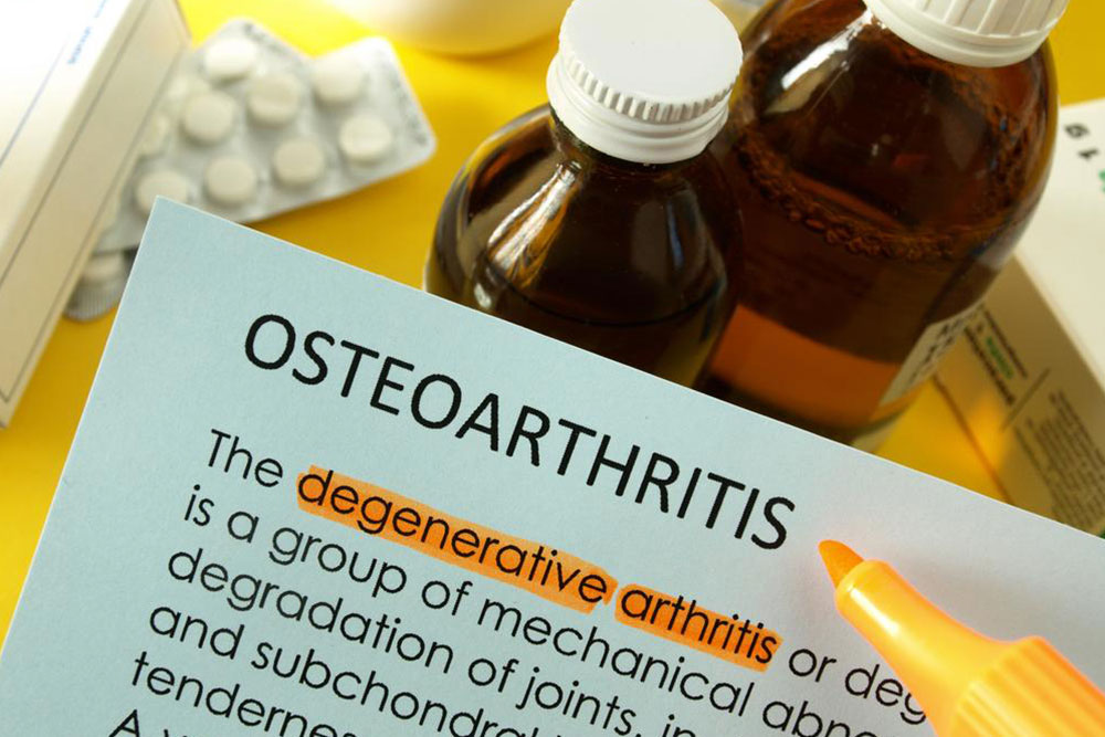 Osteoarthritis &#8211; How to Treat it